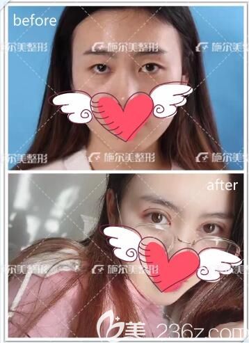 美瞳術(shù)+雙眼皮前后對比照