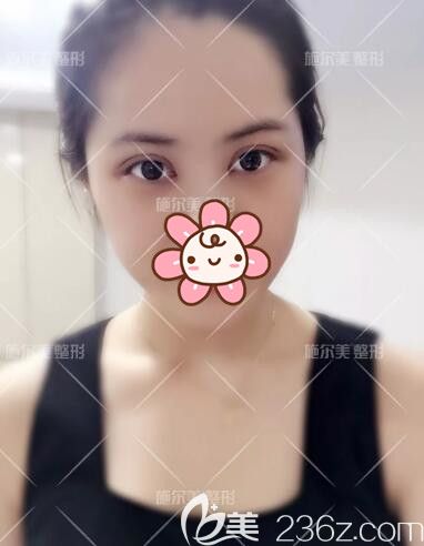 一周到常州施爾美拆線眼綜合效果