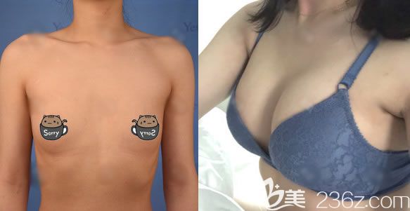 溫州藝星徐淑卿假體隆胸案例