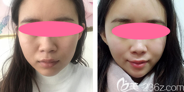 分享我在贛州韓美整形瘦臉一個月前后對比圖 分享我在贛州韓美整形瘦臉一個月前后對比圖