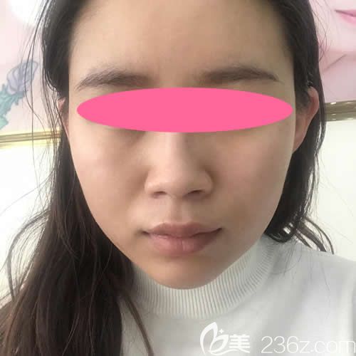 在贛州韓美整形注射瘦臉前的照片 在贛州韓美整形注射瘦臉前的照片