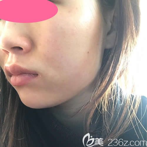 在贛州韓美整形注射瘦臉第5天效果 在贛州韓美整形注射瘦臉第5天效果