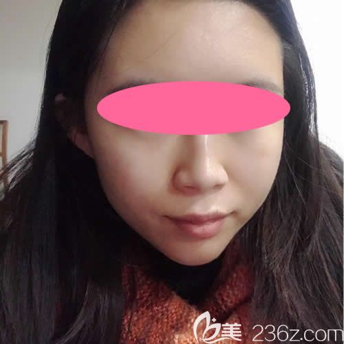 在贛州韓美注射瘦臉術后第10天效果 在贛州韓美注射瘦臉術后第10天效果