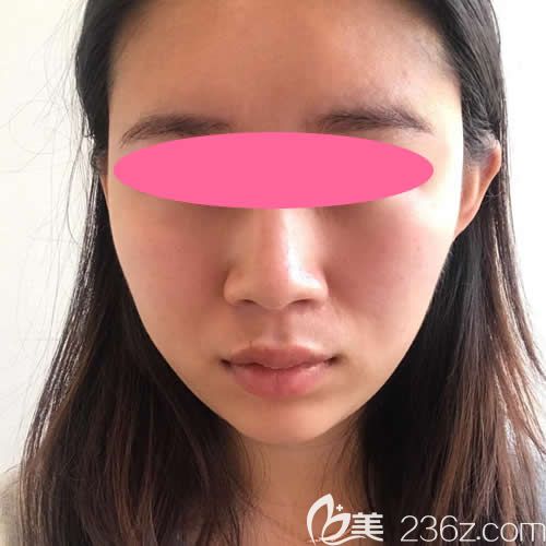 在贛州韓美整形醫(yī)院打瘦臉除皺瘦臉術后第23天效果圖 在贛州韓美整形醫(yī)院打瘦臉除皺瘦臉術后第23天效果圖