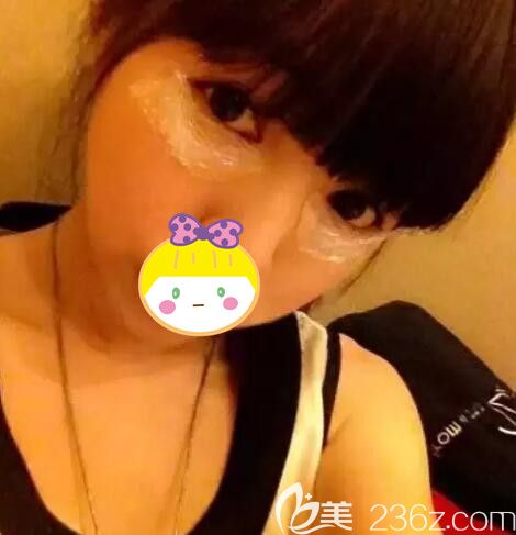 玻尿酸豐臥蠶術前敷麻藥 玻尿酸豐臥蠶術前敷麻藥