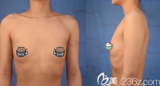 溫州藝星整形醫(yī)院做隆胸術(shù)前 溫州藝星整形醫(yī)院做隆胸術(shù)前