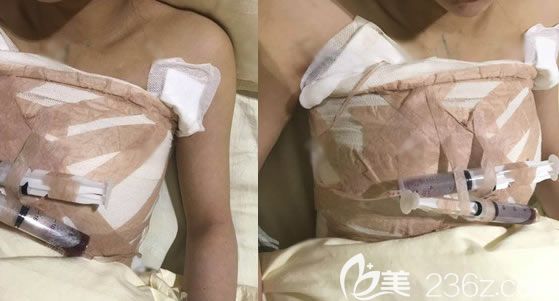 溫州藝星醫(yī)院剛做完隆胸的照片 溫州藝星醫(yī)院剛做完隆胸的照片