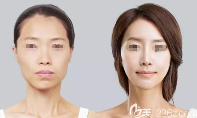 周海峰微整抗衰案例 周海峰微整抗衰案例