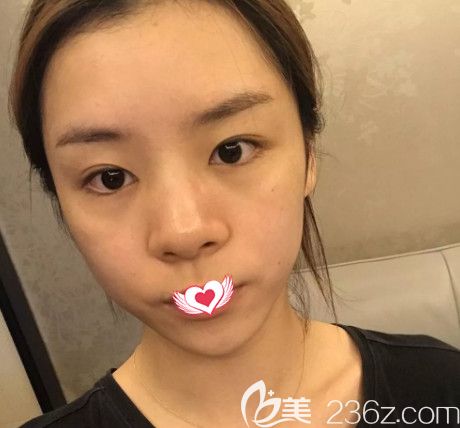 雅芳亞整形院長劉莎莎為我做鼻綜合術前是扁平的鼻子 雅芳亞整形院長劉莎莎為我做鼻綜合術前是扁平的鼻子