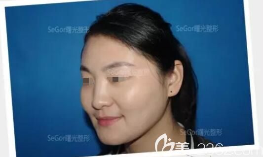 面診常州曙光術(shù)前咬肌肥大 面診常州曙光術(shù)前咬肌肥大