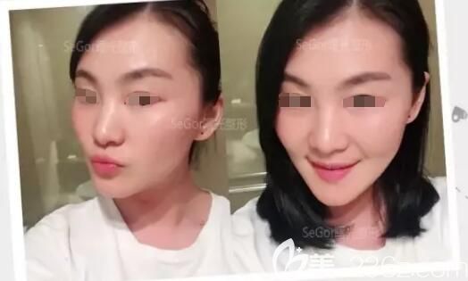 剛注射完瘦臉除皺瘦臉天 剛注射完瘦臉除皺瘦臉天