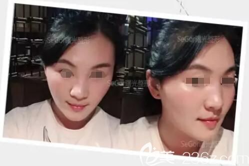 分享瘦臉除皺瘦臉術(shù)后三天蛻變 分享瘦臉除皺瘦臉術(shù)后三天蛻變