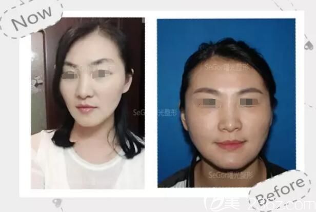 一開(kāi)始也擔(dān)心瘦臉除皺瘦臉副作用的我，沒(méi)想到在常州曙光醫(yī)生親診下嘗試了一次居然想定期注射