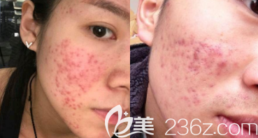 長痘和痘坑的臉