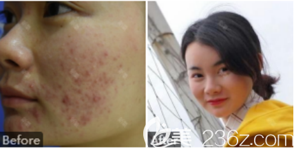 激光治療痘坑的案例二