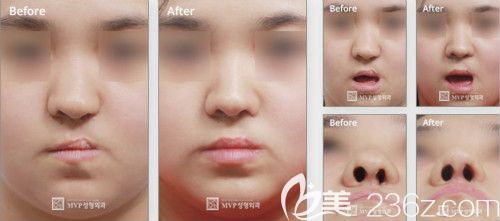 韓國mvp崔宇植院長(zhǎng)修復(fù)二期唇裂鼻