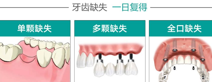 沈陽歡爾口腔即刻種植牙優(yōu)勢