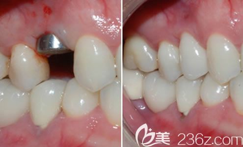 歡樂口腔沈陽分院張桂靜醫(yī)生單顆牙缺失種植案例