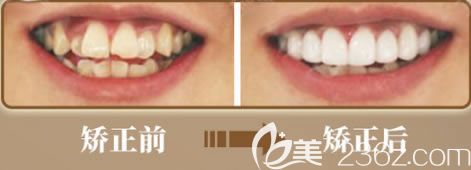 歡樂口腔肖主任成人牙齒擁擠+虎牙矯正前后對比照片 歡樂口腔肖主任成人牙齒擁擠+虎牙矯正前后對比照片