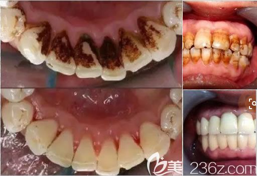 沈陽歡樂口腔王可主任洗牙及牙周治療案例 沈陽歡樂口腔王可主任洗牙及牙周治療案例