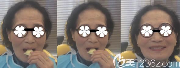 張女士選擇吸附性全口義齒后的效果圖 張女士選擇吸附性全口義齒后的效果圖