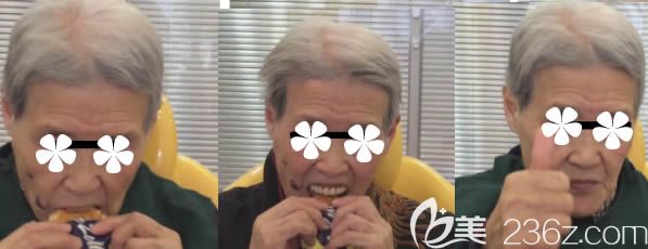 劉女士做完BPS生物功能性全口義齒后的效果 劉女士做完BPS生物功能性全口義齒后的效果