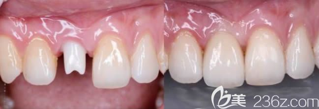 沈陽歡樂口腔李春玲醫(yī)生前門牙全瓷冠修復(fù)效果圖 沈陽歡樂口腔李春玲醫(yī)生前門牙全瓷冠修復(fù)效果圖