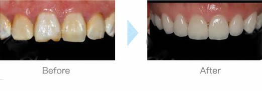 沈陽(yáng)歡樂(lè)口腔尹醫(yī)生茶漬牙選擇做全瓷美學(xué)修復(fù)后的對(duì)比照片 沈陽(yáng)歡樂(lè)口腔尹醫(yī)生茶漬牙選擇做全瓷美學(xué)修復(fù)后的對(duì)比照片