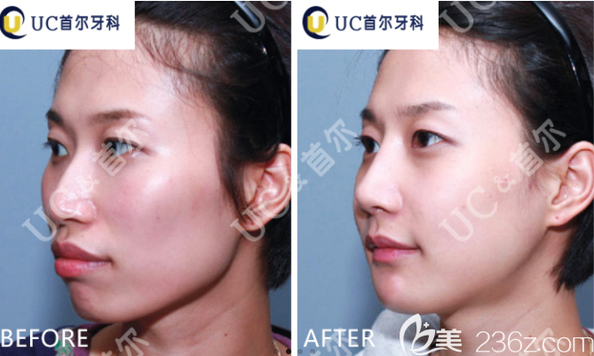 韓國UC首爾牙科醫(yī)院突嘴矯正手術