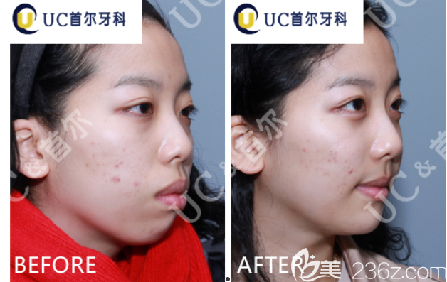 韓國UC首爾牙科醫(yī)院突嘴矯正案例