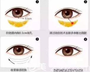 眼袋去除手術(shù)