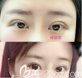 雙眼皮修復(fù)案例