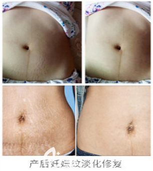 去除妊娠紋手術(shù)的案例