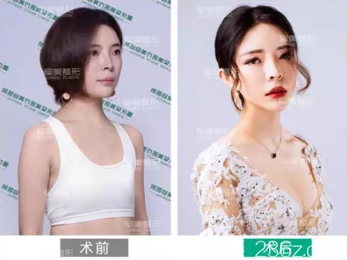 重慶軍美隆胸案例