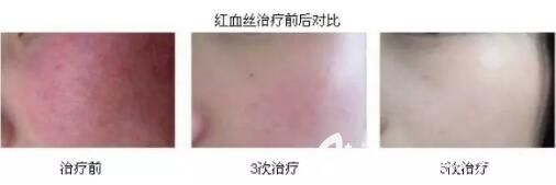 沈陽名流K8舒敏之星治療紅血絲真人前后效果對比