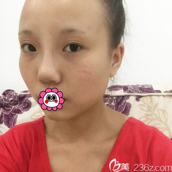 黑龍江瑞麗鼻整形前照片 黑龍江瑞麗鼻整形前照片