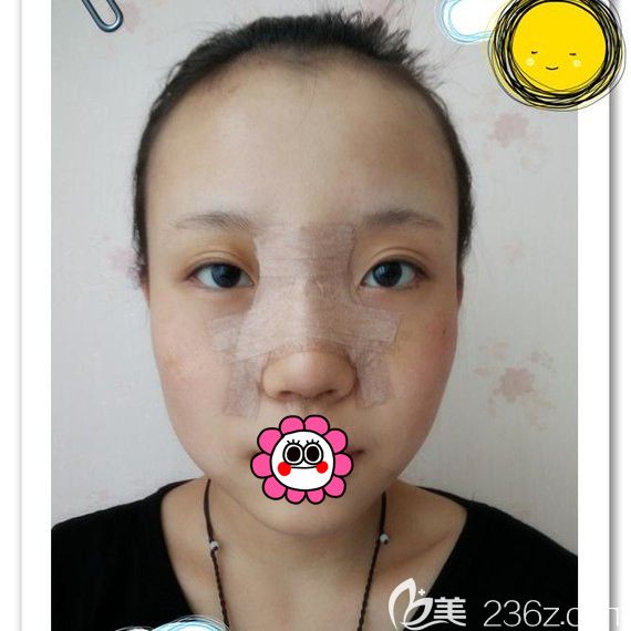 黑龍江瑞麗鼻整形術(shù)后5天 黑龍江瑞麗鼻整形術(shù)后5天