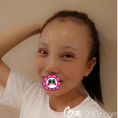 黑龍江瑞麗切開雙眼皮術(shù)后4天 黑龍江瑞麗切開雙眼皮術(shù)后4天
