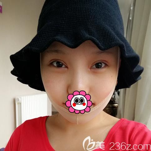 黑龍江瑞麗隆下巴術(shù)后恢復(fù) 黑龍江瑞麗隆下巴術(shù)后恢復(fù)