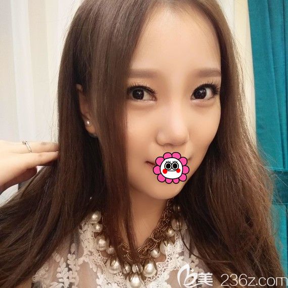 大家看我到黑龍江瑞麗找楊永勝做了鼻綜合后又做了雙眼皮隆下巴，戳開看心得體會(huì)和恢復(fù)效果