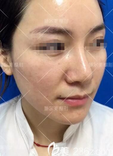 面診常州施爾美術(shù)前油性皮膚總長(zhǎng)痘 面診常州施爾美術(shù)前油性皮膚總長(zhǎng)痘