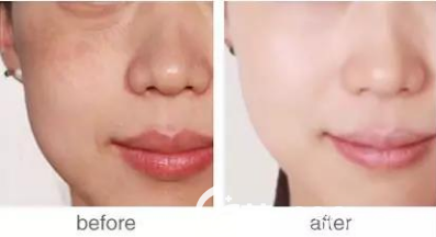 成都成美整形美容醫(yī)院祛斑前后對比效果