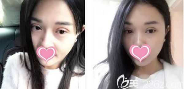 在昆明美伊萊整形做失敗雙眼皮修復前 在昆明美伊萊整形做失敗雙眼皮修復前