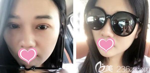 雙眼皮修復手術7天形狀很滿意 雙眼皮修復手術7天形狀很滿意