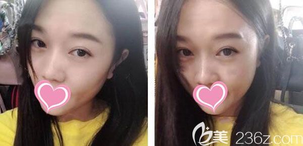 雙眼皮修復手術20天疤痕恢復得<span style= 雙眼皮修復手術20天疤痕恢復得<span style=