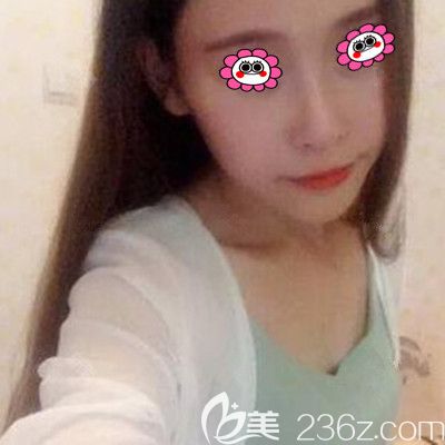 自體脂肪豐胸前的照片 自體脂肪豐胸前的照片