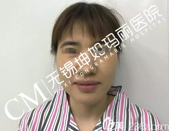 術(shù)前坤如瑪麗員工鼻子缺陷較大 術(shù)前坤如瑪麗員工鼻子缺陷較大