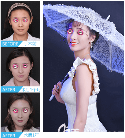 北京沃爾整形劉彥軍醫(yī)生半肋鼻綜合隆鼻案例