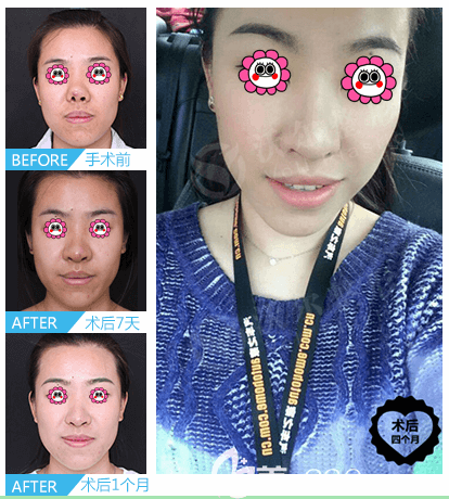 北京沃爾整形劉彥軍醫(yī)生疑難鼻修復(fù)案例