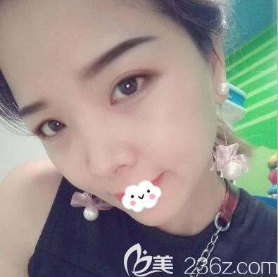 程紅濤院長去眼袋術(shù)后6天 程紅濤院長去眼袋術(shù)后6天